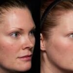 laser brown spot removal