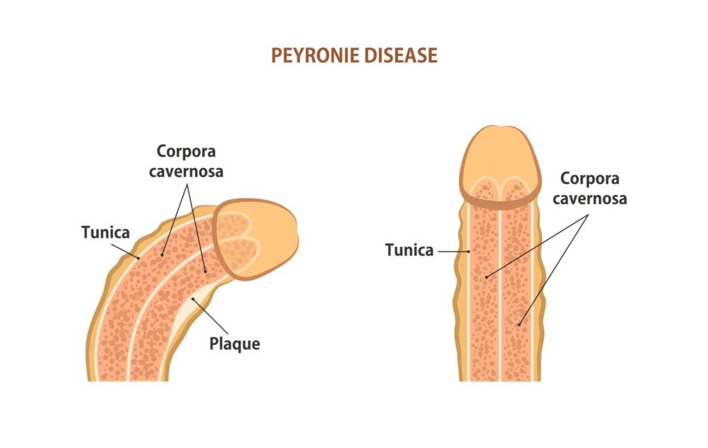 Peyronie’s Disease and Erectile Dysfunction: What’s the Connection?