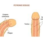 Peyronie’s Disease and Erectile Dysfunction: What’s the Connection?